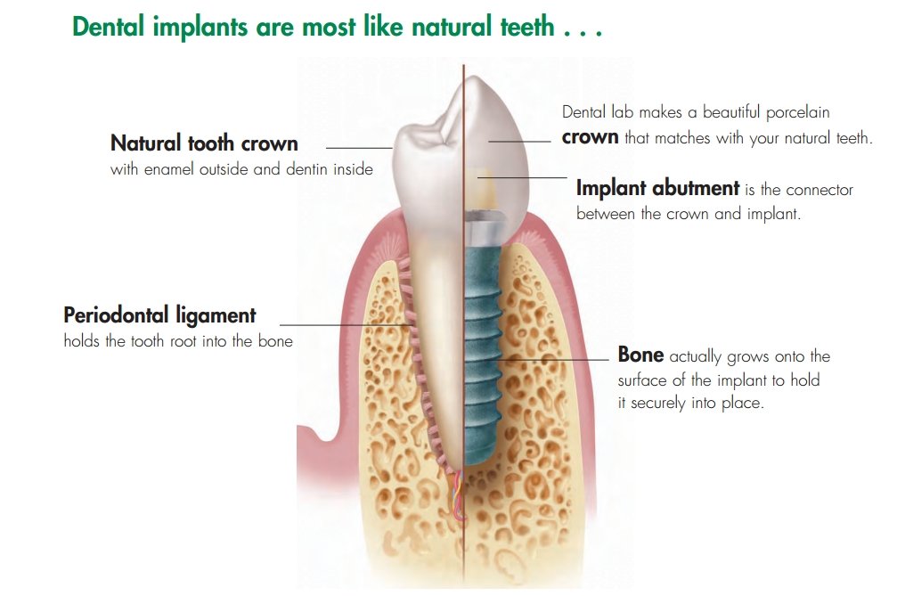 dental implants tooth