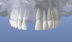 dentalimplant 03
